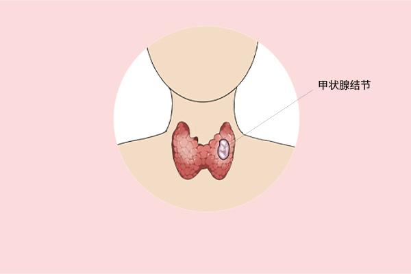 甲狀腺癌癥的主要癥狀表現(xiàn)有什么？為什么會(huì)得甲狀腺癌癥呢？