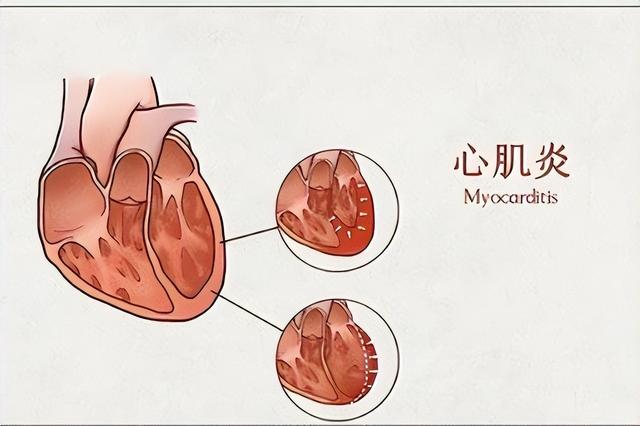 心肌炎的癥狀有哪些？心肌炎的主要變現(xiàn)癥狀有啥？